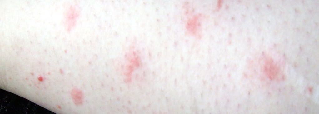 Red Splotches On Lower Legs Skin Problems And Treatments Community Support Group