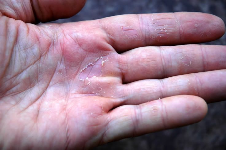 Cracked, Bloody Hands And Fingers :: Supertopo Rock Climbing Discussion 