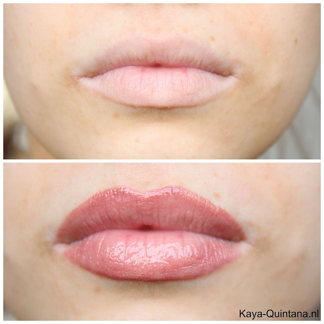 vollere lippen voor en na